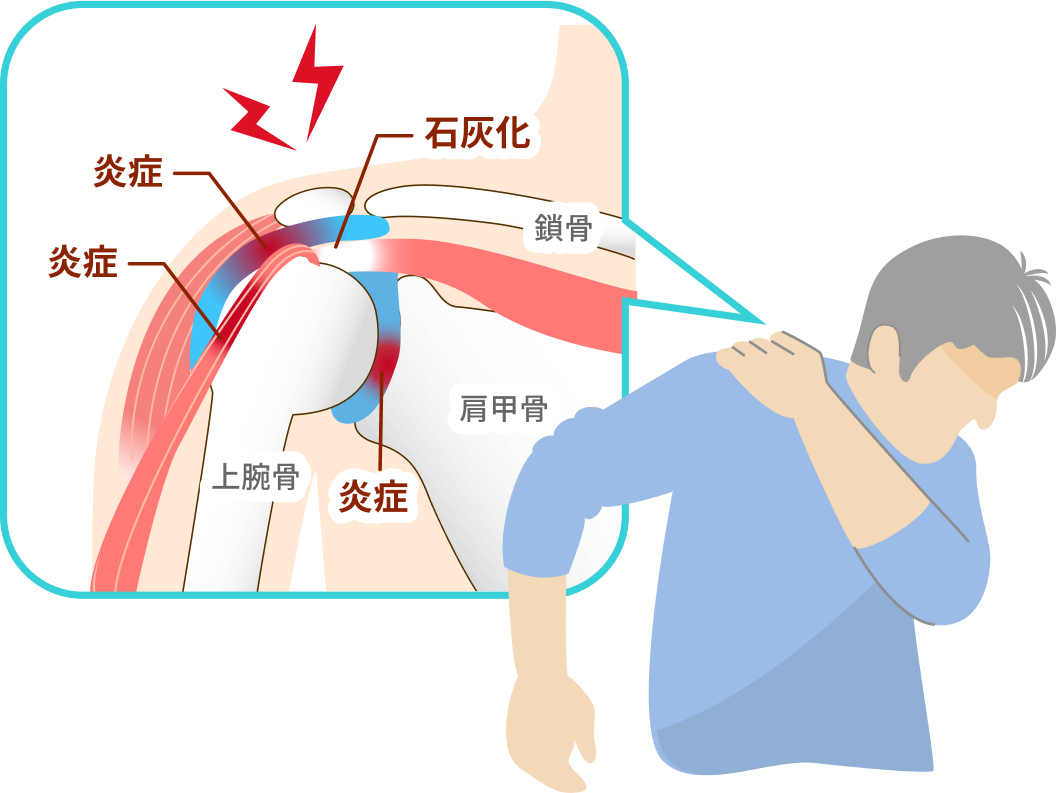 四十肩・五十肩（肩関節周囲炎）の原因はどこに？