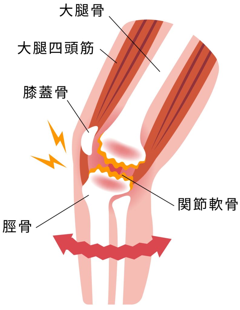 膝の痛みの原因とは？