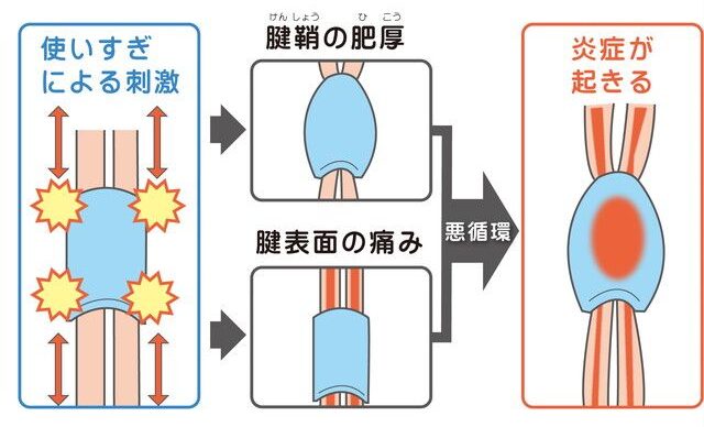 腱鞘炎の原因